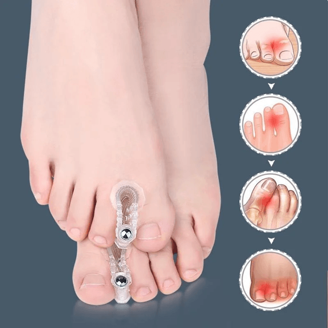 AlignEase Bunion Corrector  Toe Spreader Set  Hallux Valgus Relief Tool 1