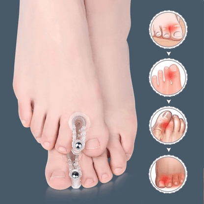 AlignEase Bunion Corrector  Toe Spreader Set  Hallux Valgus Relief Tool 1
