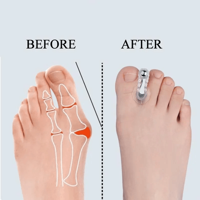 AlignEase Bunion Corrector  Toe Spreader Set  Hallux Valgus Relief Tool 3