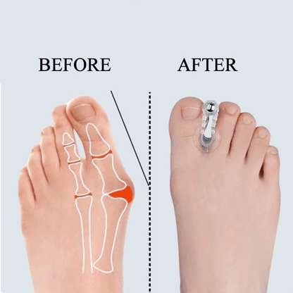 AlignEase Bunion Corrector  Toe Spreader Set  Hallux Valgus Relief Tool 3