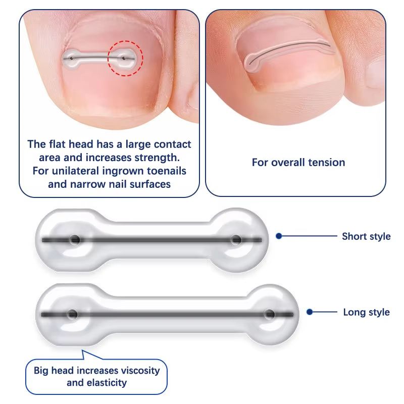 Ingrown Toenail Correction Patch Set Elastic Toe Nail Brace Pedicure Tool 1