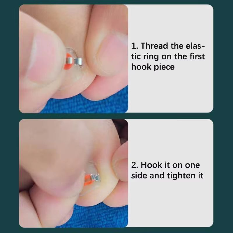 Professional Ingrown Toenail Corrector Tool Set  Pedicure Treatment  Foot Care Kit 4