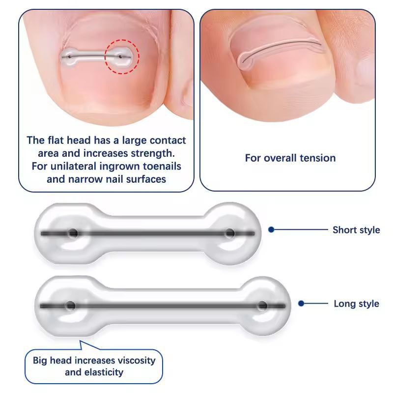 Precision Ingrown Toenail Correction Patch Set  Professional Toe Brace  Treatment Tool 1