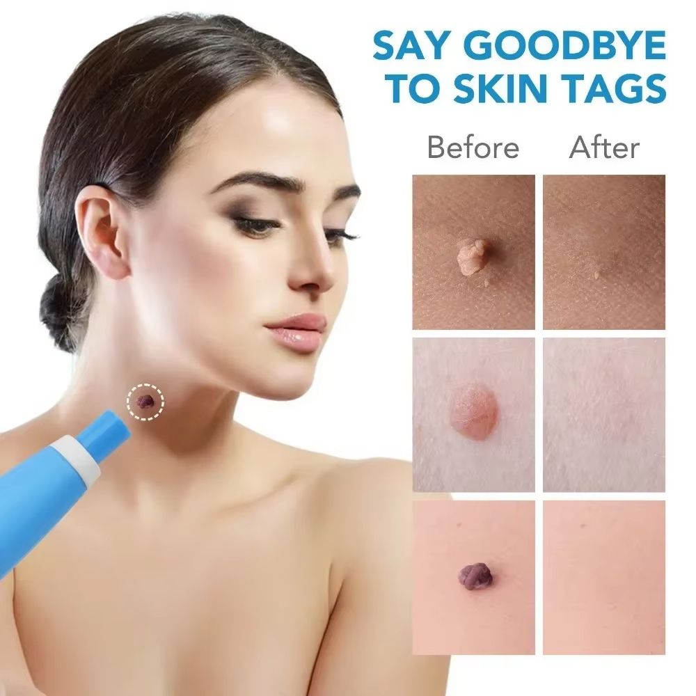 2 In 1 Painless Skin Tag And Mole Removal Kit 3