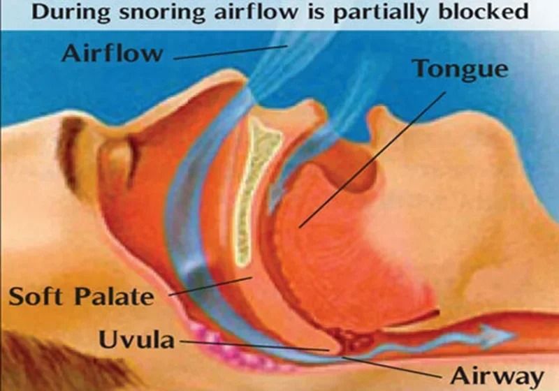 Anti Snoring Nose Clip Set For Better Breathing And Restful Sleep 3