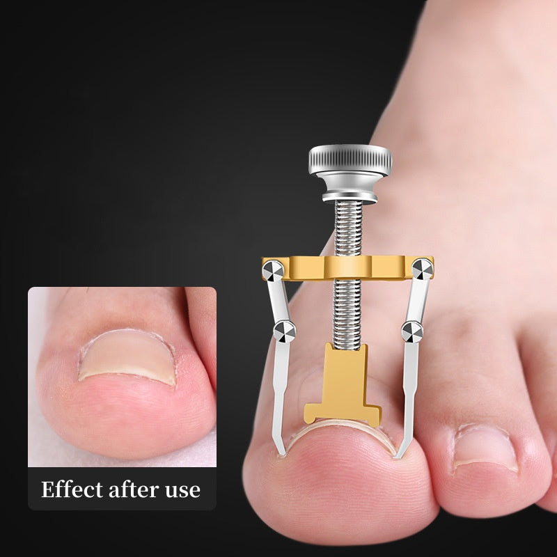Toenail Straightening Clip Ingrown Toenail Lifter Stainless Steel Foot Care Corrector 1