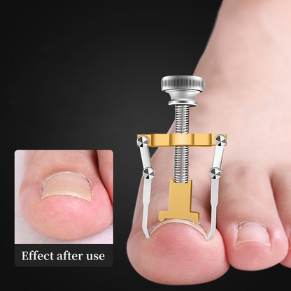 Toenail Straightening Clip Ingrown Toenail Lifter Stainless Steel Foot Care Corrector 1