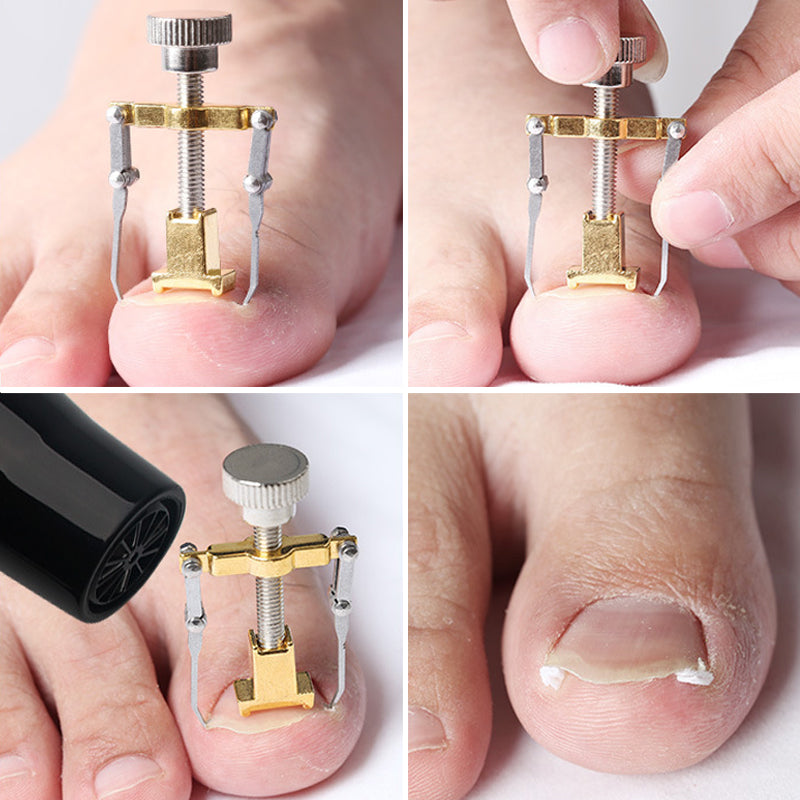 Toenail Straightening Clip Ingrown Toenail Lifter Stainless Steel Foot Care Corrector 2
