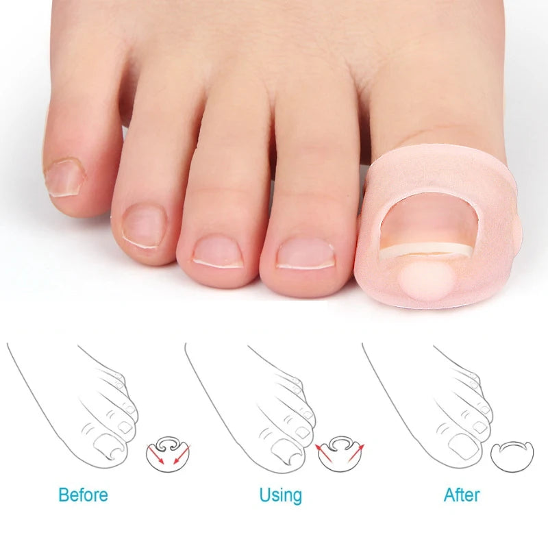Invisible Ingrown Toenail Correction Tool, Silicone Toe Nail Cover, Elastic Straightening Clip Brace