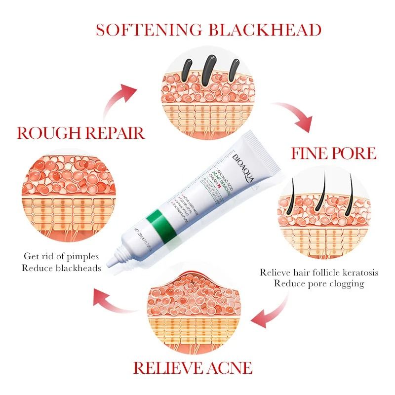 Salicylic Acid Acne Cream For Blackhead Removal And Mark Repair 1